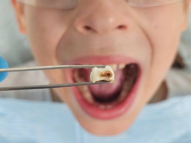 Best Emergency Treatment for Dental Infections or Abscesses in Black Creek, WI